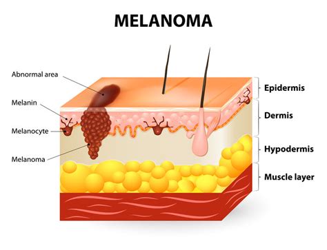 skin structures affected by melanoma